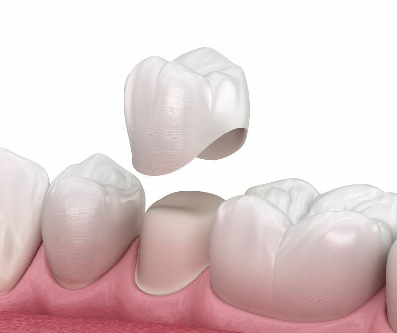 dental crown placement