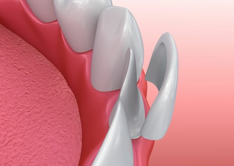 Veneers image