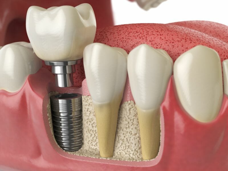 Dental Implants in Lyons